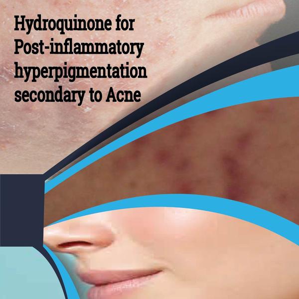 Hydroquinone for Post-inflammatory hyperpigmentation secondary to Acne